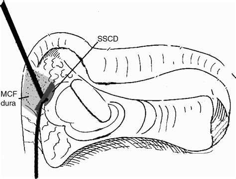 Transmastoid Repair Of Superior Semicircular Canal Dehiscence The Journal Of Laryngology