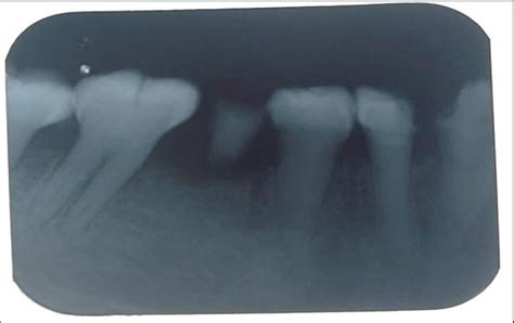 Periapical radiograph showing bulbous crown, cervical constriction ...