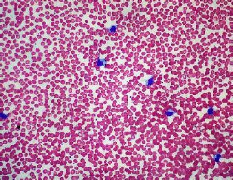 Blood Smear Test: Procedure, Staining & Interpretation | Study.com