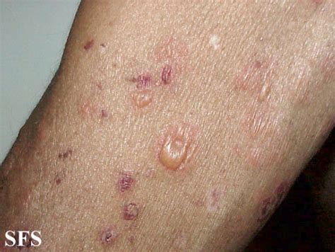 Bullous pemphigoid - wikidoc