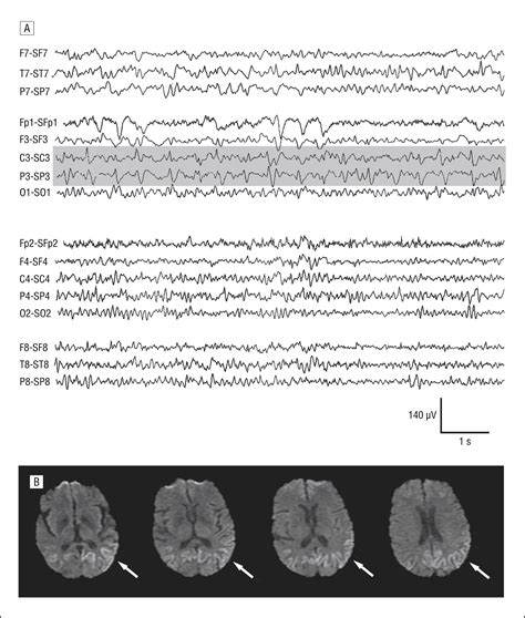 Creutzfeldt Jakob Disease With Focal Electroencephalographic And