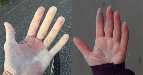 Fen Meno De Raynaud Y Acrocianosis Diferencias Entre La Coloraci N De