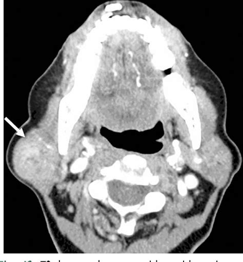 Figure 12 From Pitfalls In The Staging Of Cancer Of The Major Salivary