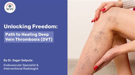 Comprehensive Services For Deep Vein Thrombosis Dvt Slvc Clinic