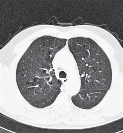 Lungs Radiology Key