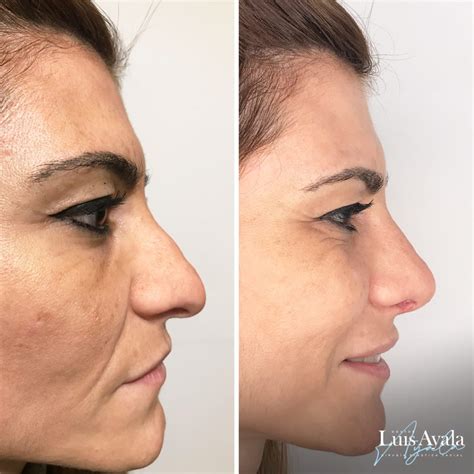 Fotograf As Antes Y Despu S De Rinoplastias Dr Luis Ayala