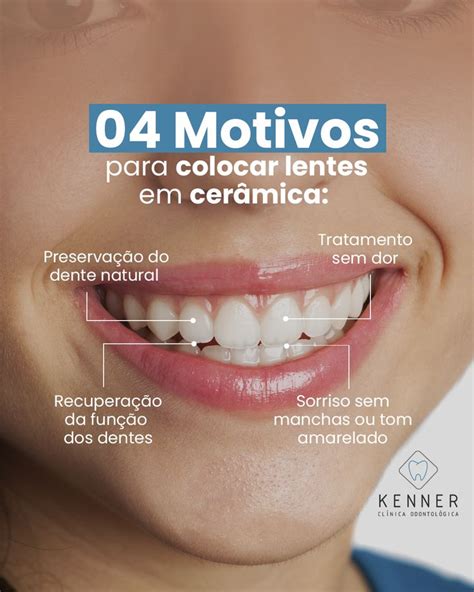 Lentes De Contato Sorriso Perfeito Excel Ncia Odontol Gica Est Tica