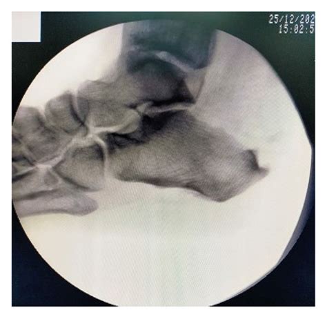 Intraoperative Fluoroscopic A And Arthroscopic B Images Showing