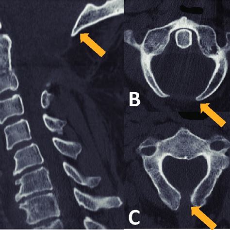 Illustration Of Disc Osteophyte Complex Size Measurement Download Scientific Diagram