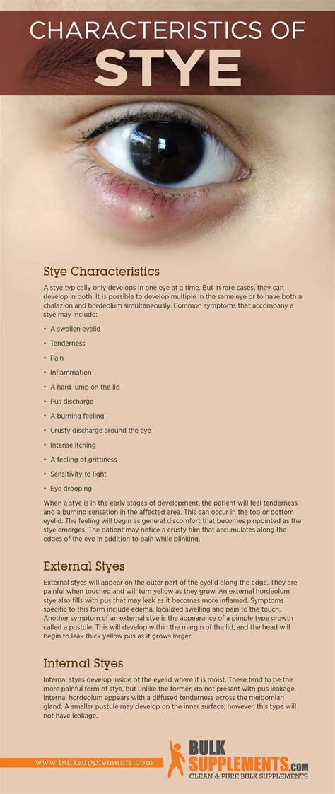 Stye: Characteristics, Causes & Treatment