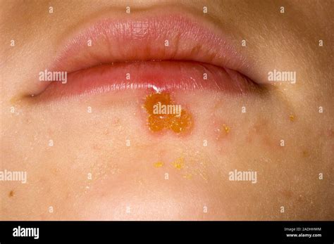 Model Released Impetigo Rash On A 6 Year Old Boys Chin Impetigo Is A