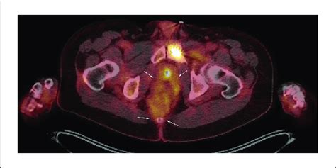 Positron Emission Tomography Petcomputed Tomography Ct Scan