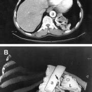 Spiral CT scan of case 2. (A) Contrast enhanced CT axial image showing... | Download Scientific ...