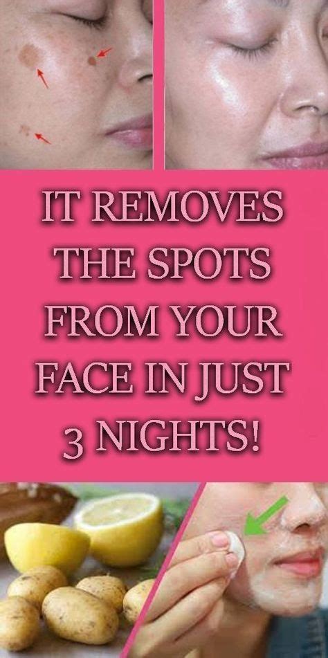 Natural Home Remedy To Clear Your Skin Of Dark Spots Or