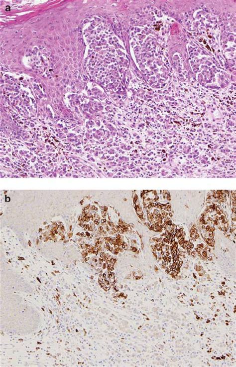 A case of acral-lentiginous melanoma showing strong and diffuse... | Download Scientific Diagram