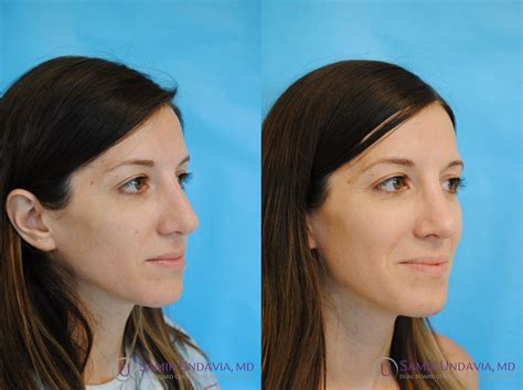 Revision Rhinoplasty Before And After