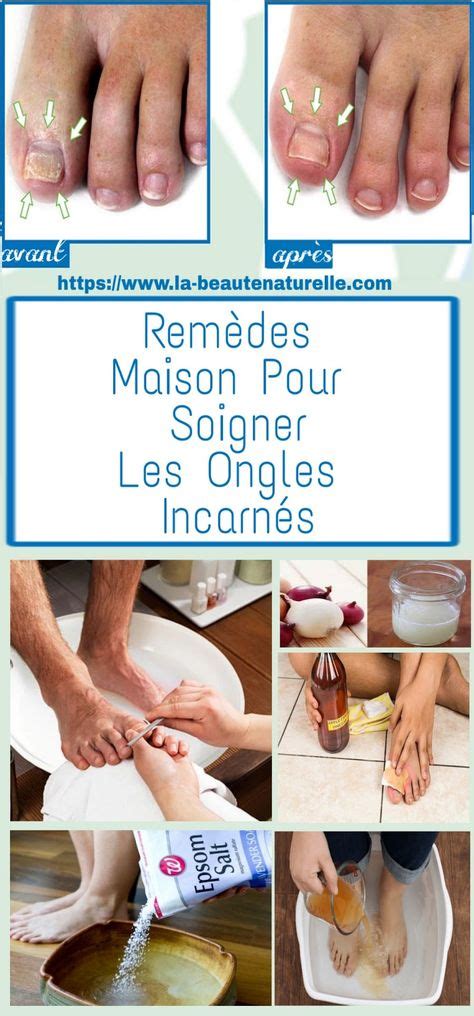 Remèdes Maison Pour Soigner Les Ongles Incarnés Avec Images Ongles