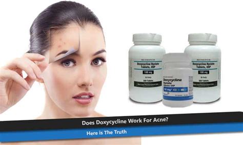 Does Doxycycline Work For Acne? Here is The Truth