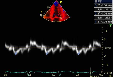 Amyloidosis Echocardiographic Appearance Brigham And Womens Hospital