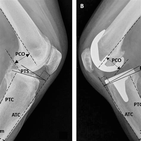 Preoperative A And Postoperative B Radiographs Showing Schematic