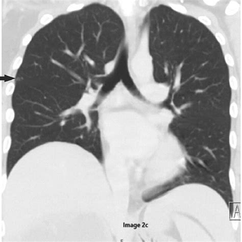 Initial Ct Scan Chest Sagittal View The Image Is Showing A Tiny Download Scientific Diagram