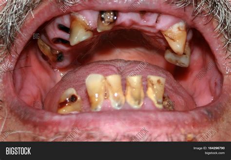 Rotten Bad Teeth. Image & Photo (Free Trial) | Bigstock