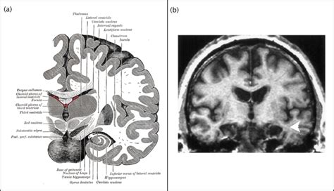 4: (a) Illustration showing the location of medial temporal lobe... | Download Scientific Diagram