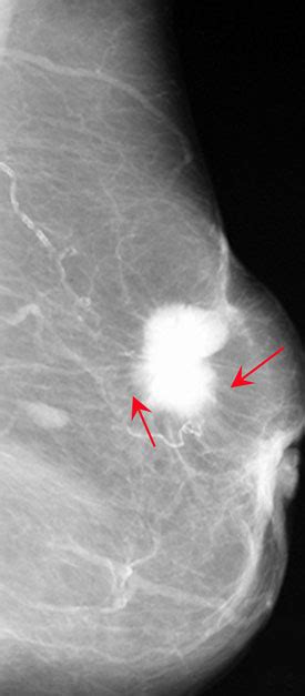 乳腺癌钼靶x线影像表现 医学影像图医学图库