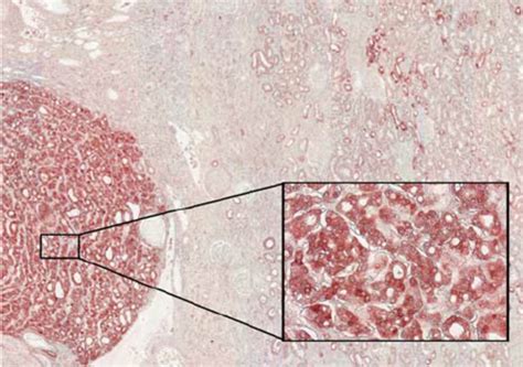 Pv As A Marker Of Chromophobe Rcc Immunohistochemical Analysis Reveals