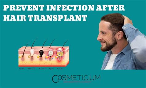 Prevent Infection After Hair Transplant – Here’s What to Do! - Cosmeticium