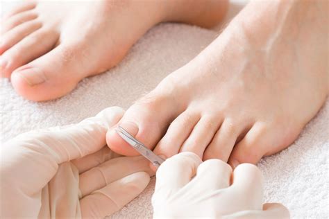 Ingrown Toenails Removal Oregon Institute Of Foot Care