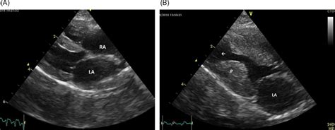 Twodimensional Echocardiographic Images A Right Parasternal Long