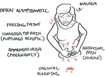 Ectopic Pregnancy Pain Location / Symptoms Of Ectopic Pregnancy ...