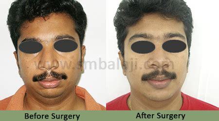 Lower Jaw Retrusion | Corrective Jaw Surgery | Cosmetic Surgery