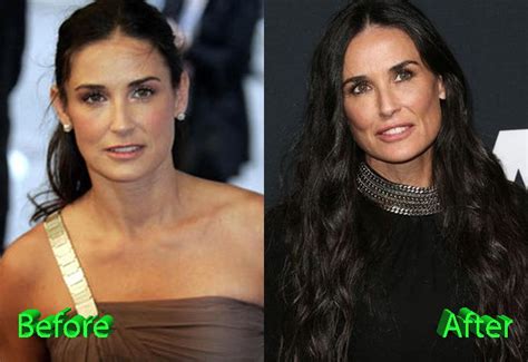 Demi Moore Plastic Surgery Gone Too Far