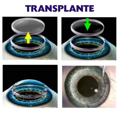 Cirurgia De Transplante De C Rnea Instituto De Olhos Minas Gerais