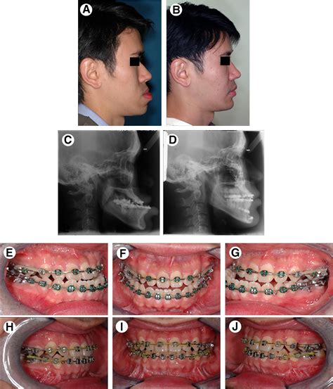 Simultaneous Modified Oblique Le Fort Iii And Segmentalized Le Fort I