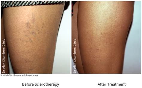 Unsightly Veins Treatments Dr Alex Chambers Medical Aesthetic Practice