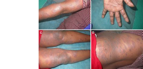 A D Hyperpigmented And Skin Colored Annular Papules And Plaques