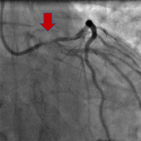 Coronary angioplasty or stenting - Central Heart