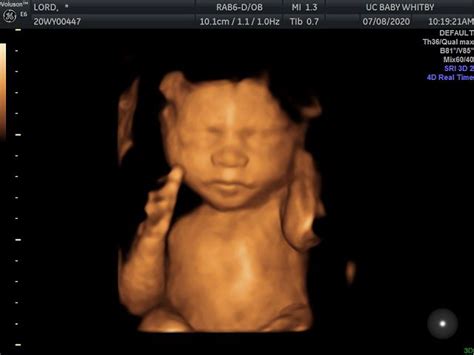 26 Weeks Ultrasound