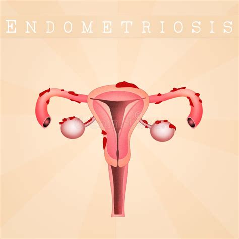 Areas In Which Endometrial Tissue Can Appear Endometriosis Endometriosis In The Body Stock