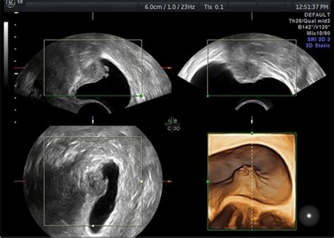 Frontiers Evaluation Of Uterosacral Ligament Involvement In 42 Off