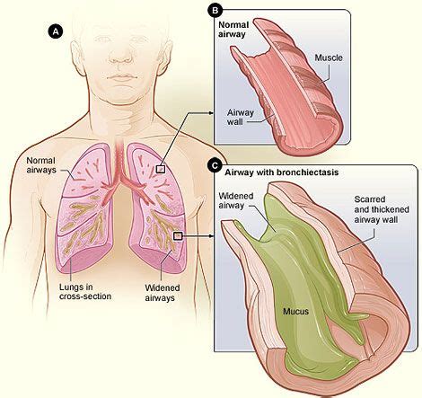 12 Bronchiectasis And Cystic Fibrosis SimpleMed Learning Medicine