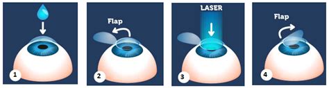 Cirugía Refractiva Barcelona Balmes 7 Cedilás Oftalmología