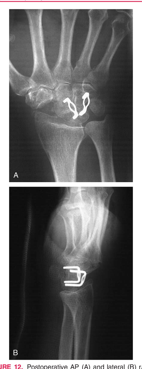 Figure 1 From Three Corner Wrist Fusion Using Memory Staples