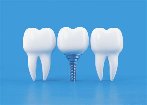 Dental Implants Implant Types Treatment And Recovery Guide