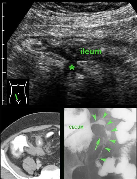 Crohn's Disease Ultrasound