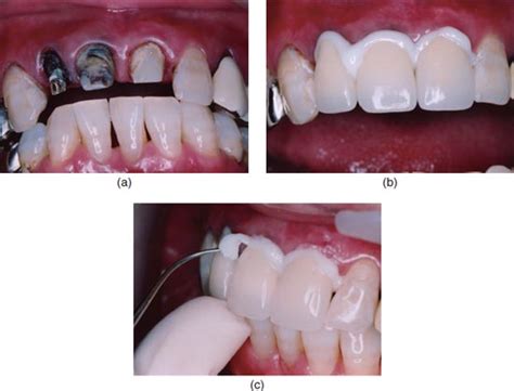 Dental Cement For Broken Tooth