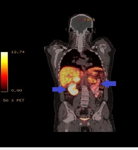 Pet Scan Image Of The Abdomen Positron Emission Tomography Scan Showing